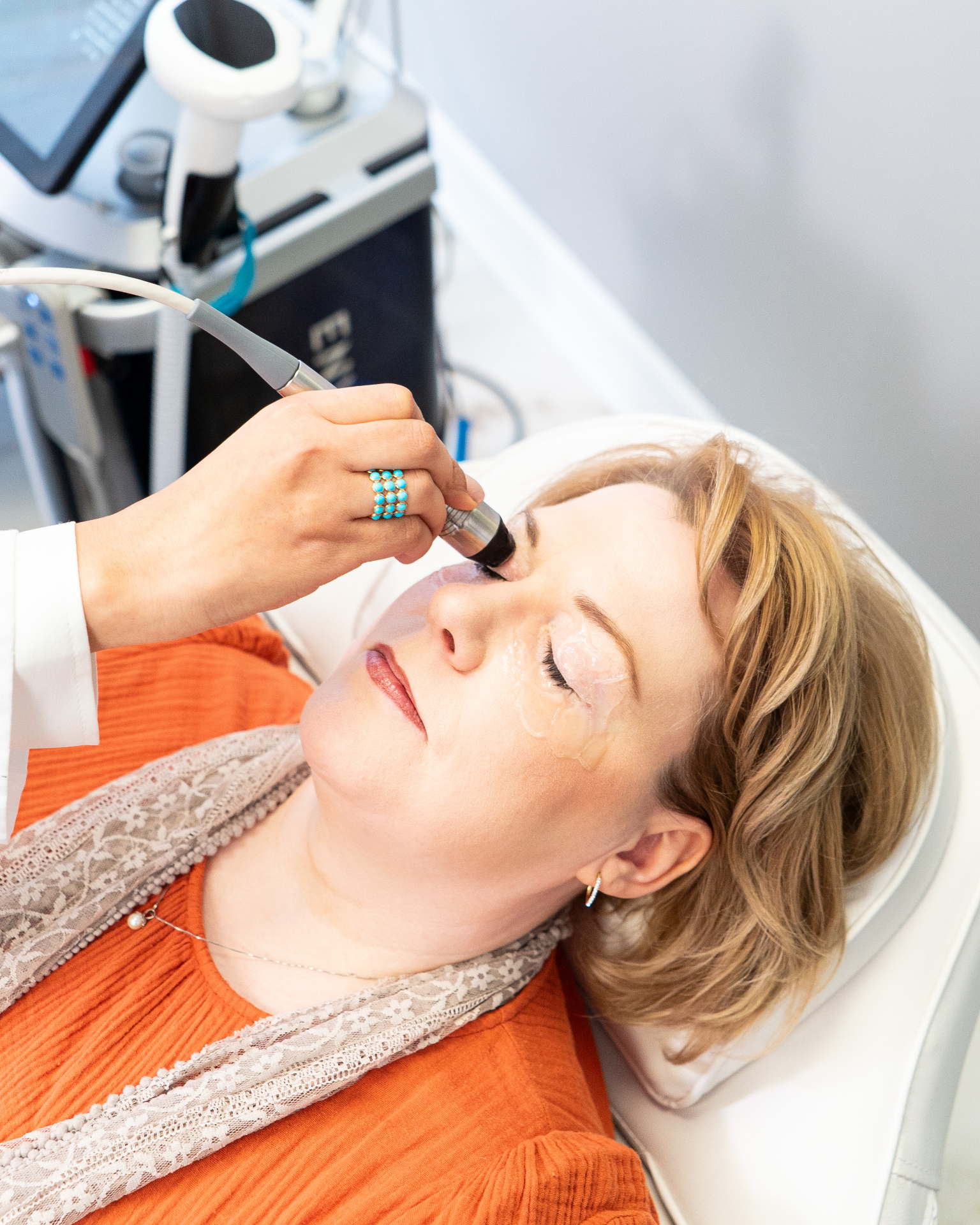 Radiofrequency for dry eye treatment at Carousel Eyecare
